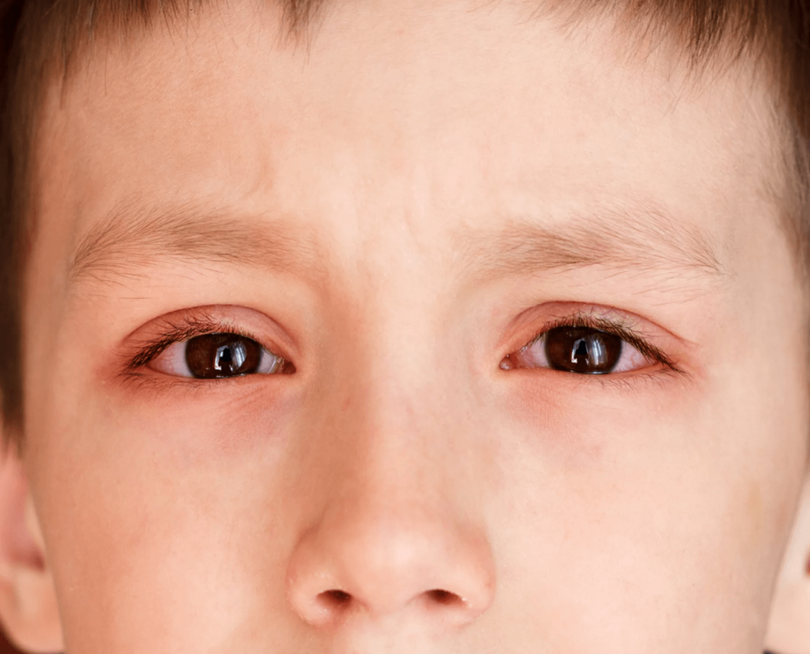 Bố mẹ cần làm gì để ngăn ngừa bệnh đau mắt đỏ ở trẻ nhỏ?